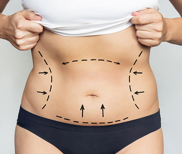 Mini tummy tuck dubai