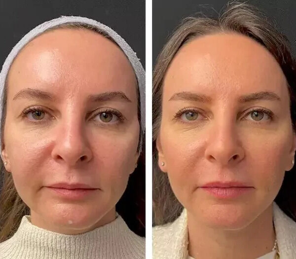 Mesotherapy in Dubai