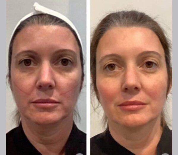 Best Aesthetic Clinic in Dubai Thread Lift Excellence Delivering Reliable Age-Defying Facial Results