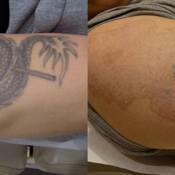 Tattoo Removal in Brentwood