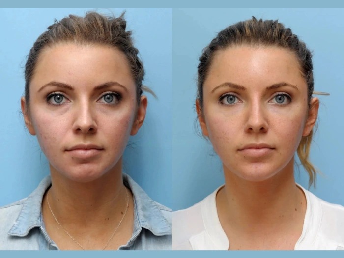 Best Plastic Surgeon in Dubai Lead Non-Surgical Thread Lift Trends