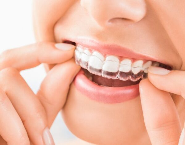 Invisalign Braces Dubai